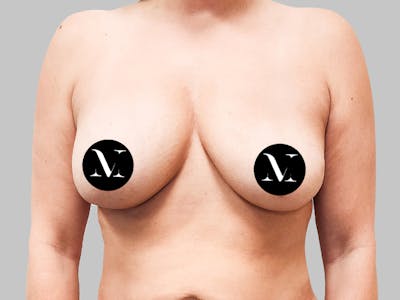 Breast Augmentation-Mastopexy Before & After Gallery - Patient 188006603 - Image 1