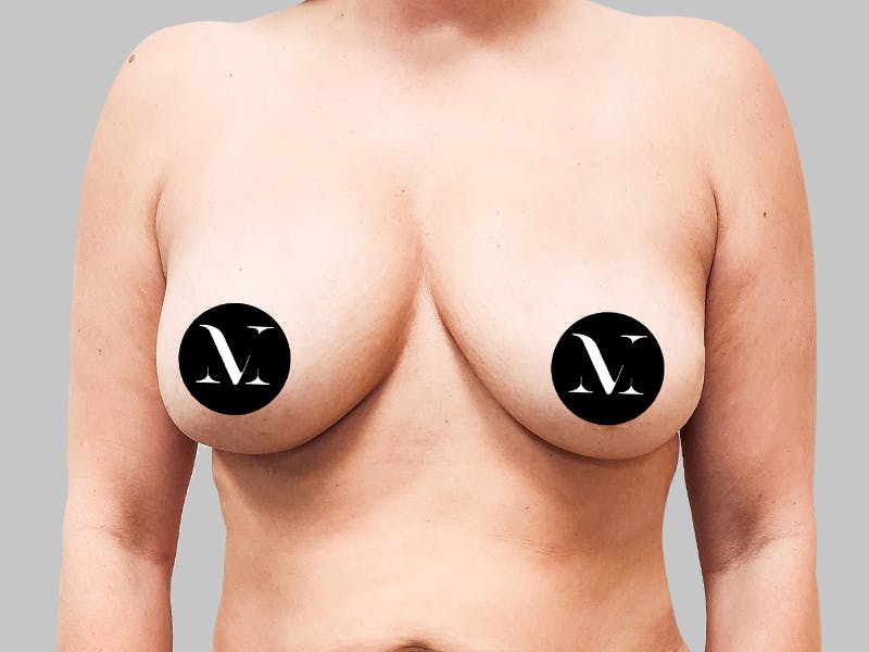 Breast Augmentation-Mastopexy Before & After Gallery - Patient 188006603 - Image 1