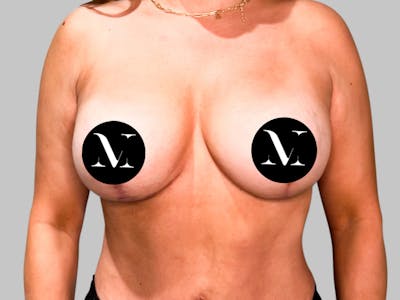 Breast Augmentation-Mastopexy Before & After Gallery - Patient 188006603 - Image 2