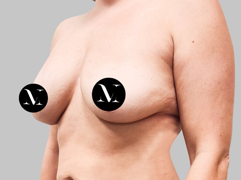 Breast Augmentation-Mastopexy Before & After Gallery - Patient 188006603 - Image 3