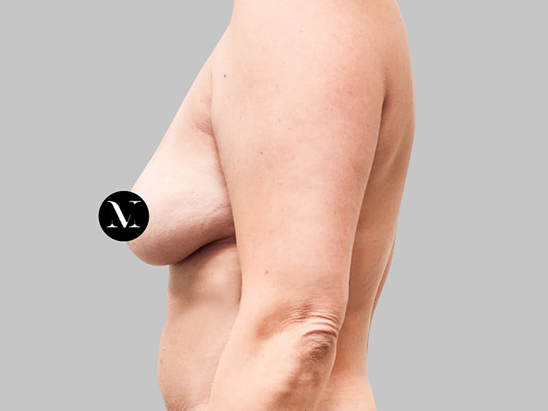 Breast Augmentation-Mastopexy Before & After Gallery - Patient 188006603 - Image 5