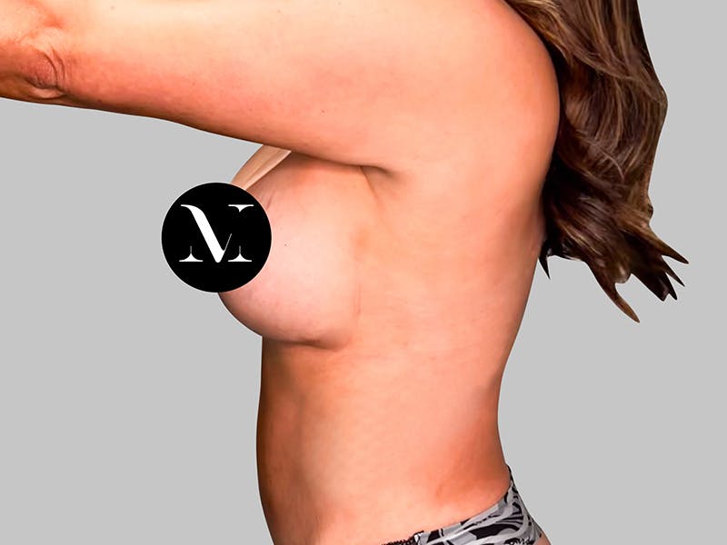 Breast Augmentation-Mastopexy Before & After Gallery - Patient 188006603 - Image 6