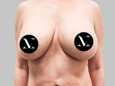 Breast Augmentation-Mastopexy Before & After Gallery - Patient 188020210 - Image 1