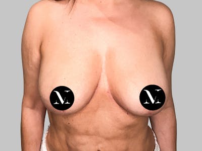 Breast Augmentation-Mastopexy Before & After Gallery - Patient 188020210 - Image 2