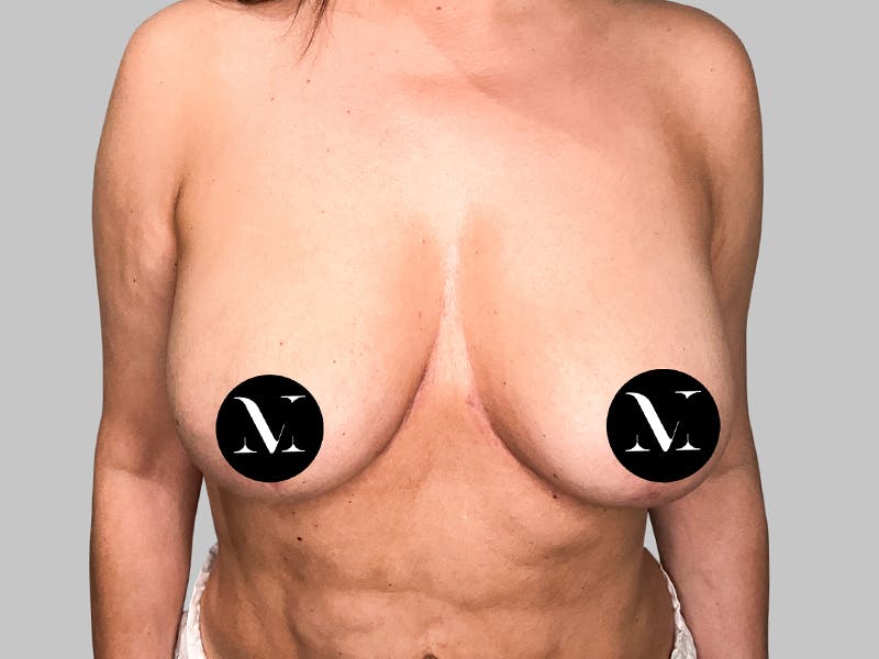 Breast Augmentation-Mastopexy Before & After Gallery - Patient 188020210 - Image 2