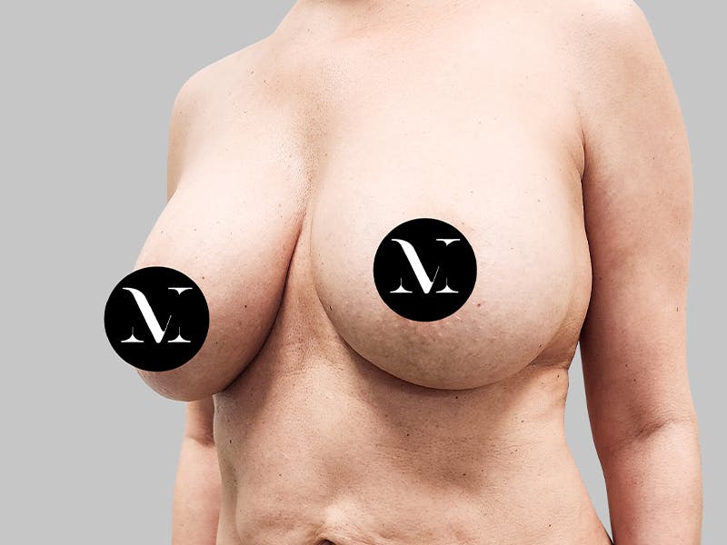 Breast Augmentation-Mastopexy Before & After Gallery - Patient 188020210 - Image 3