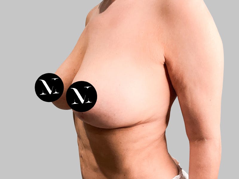 Breast Augmentation-Mastopexy Before & After Gallery - Patient 188020210 - Image 4
