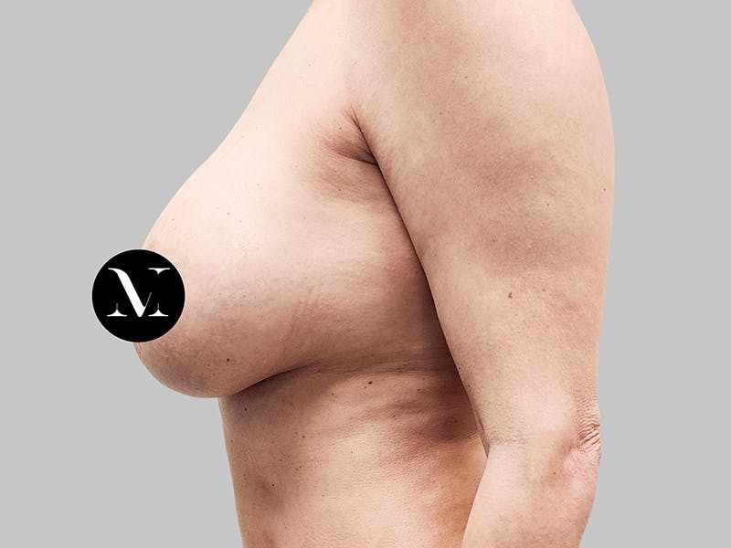 Breast Augmentation-Mastopexy Before & After Gallery - Patient 188020210 - Image 5