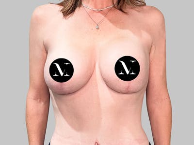 Breast Augmentation-Mastopexy Before & After Gallery - Patient 310431 - Image 2
