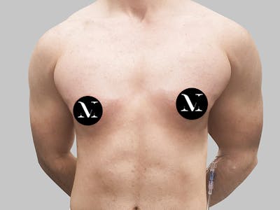 Top Surgery Before & After Gallery - Patient 188312693 - Image 1