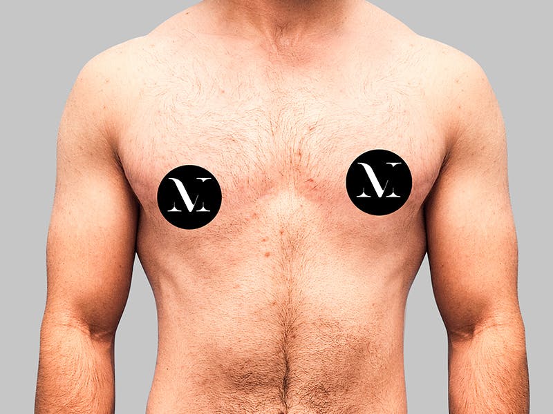 Top Surgery Before & After Gallery - Patient 188312693 - Image 2