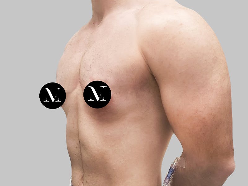 Top Surgery Before & After Gallery - Patient 188312693 - Image 3
