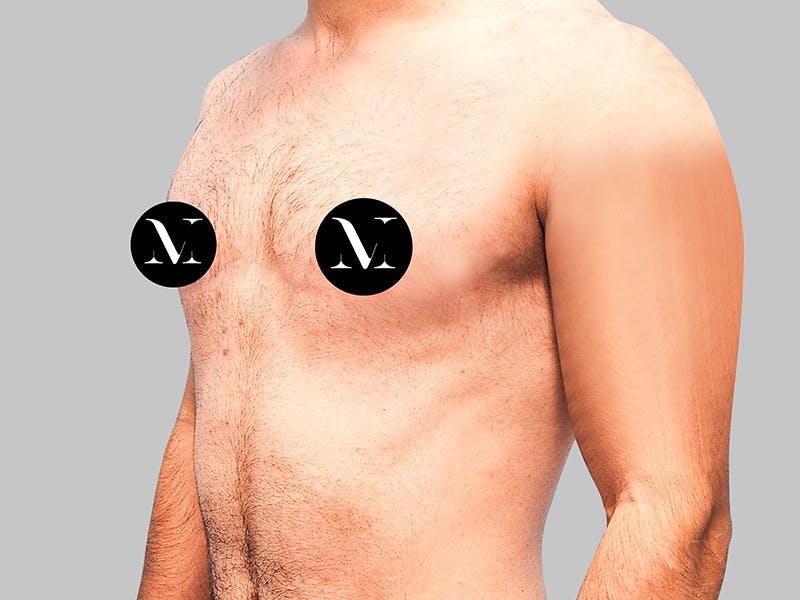 Top Surgery Before & After Gallery - Patient 188312693 - Image 4