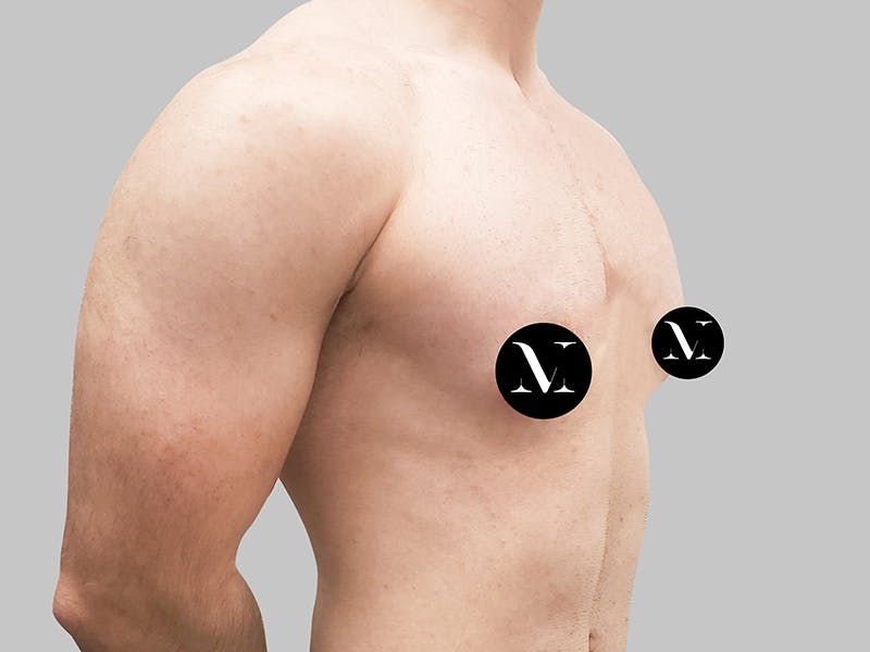 Top Surgery Before & After Gallery - Patient 188312693 - Image 5