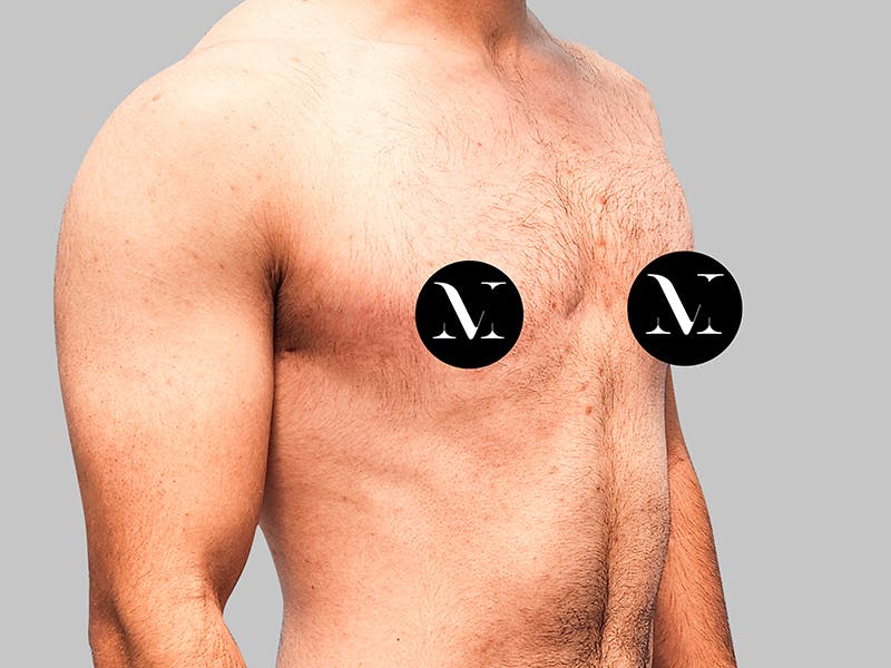 Top Surgery Before & After Gallery - Patient 188312693 - Image 6