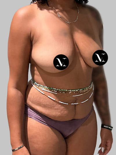 Tummy Tuck Before & After Gallery - Patient 178281 - Image 1