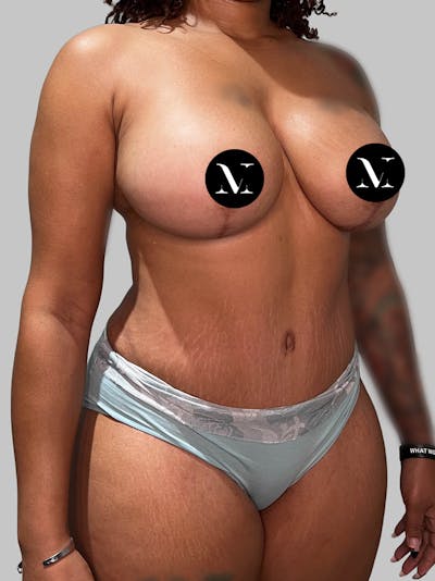 Tummy Tuck Before & After Gallery - Patient 178281 - Image 2