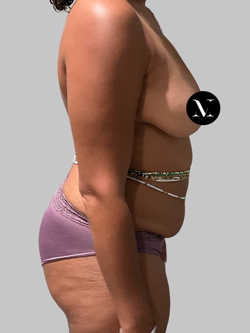 Brazilian Butt Lift Before & After Gallery - Patient 377090 - Image 3