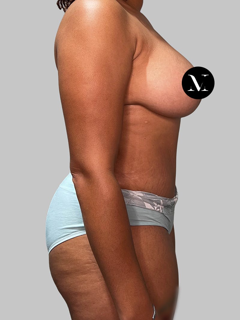 Brazilian Butt Lift Before & After Gallery - Patient 377090 - Image 4