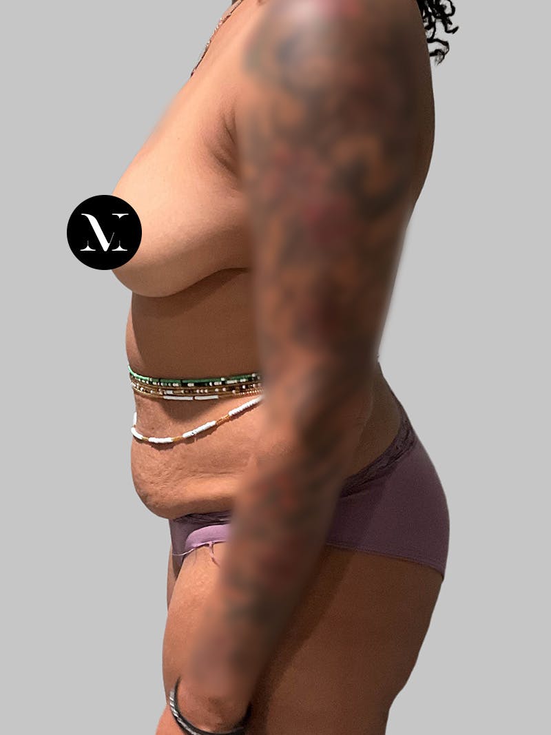 Brazilian Butt Lift Before & After Gallery - Patient 377090 - Image 5