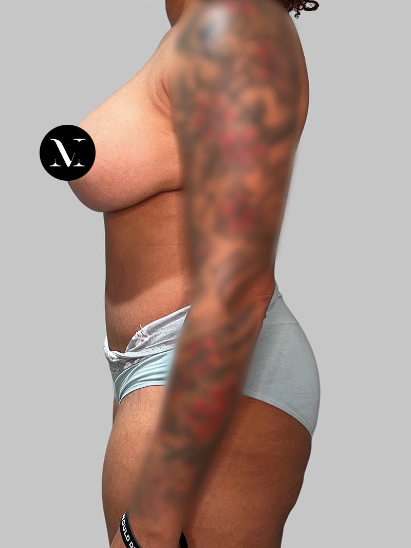 Brazilian Butt Lift Before & After Gallery - Patient 377090 - Image 6