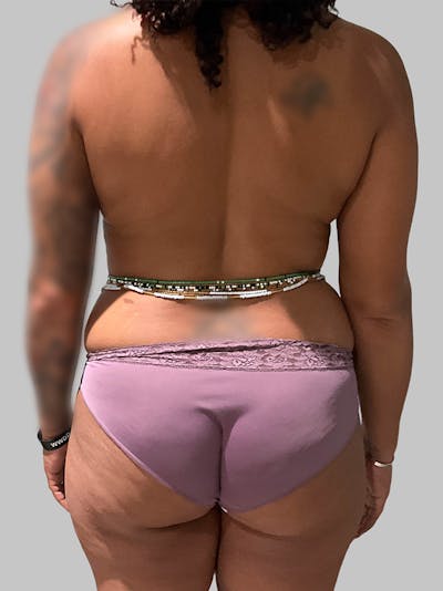Brazilian Butt Lift Before & After Gallery - Patient 377090 - Image 1