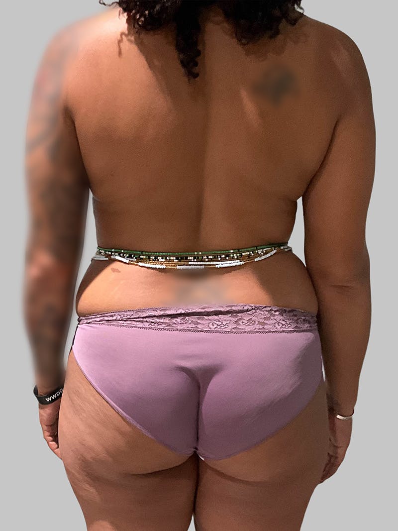 Brazilian Butt Lift Before & After Gallery - Patient 377090 - Image 1