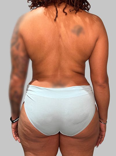 Brazilian Butt Lift Before & After Gallery - Patient 377090 - Image 2