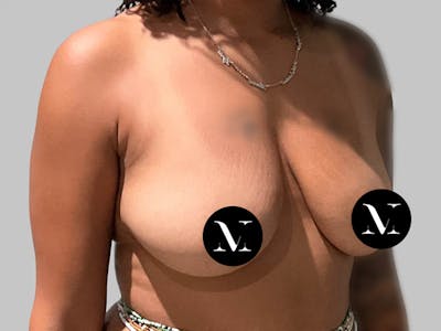 Breast Augmentation-Mastopexy Before & After Gallery - Patient 394357 - Image 1