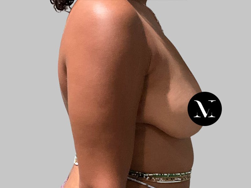 Breast Augmentation-Mastopexy Before & After Gallery - Patient 394357 - Image 3