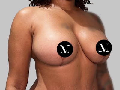 Breast Augmentation-Mastopexy Before & After Gallery - Patient 394357 - Image 2