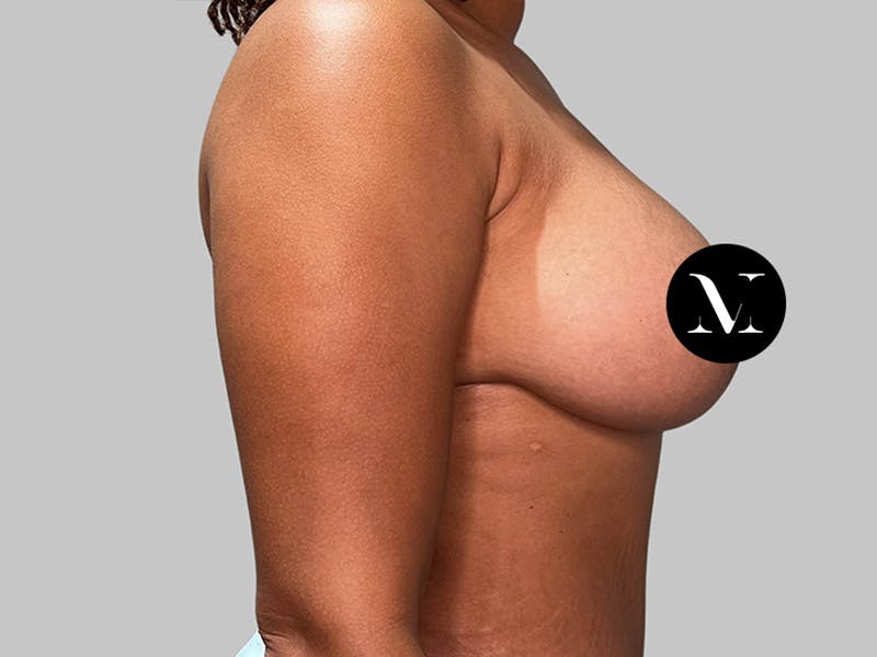 Breast Augmentation-Mastopexy Before & After Gallery - Patient 394357 - Image 4