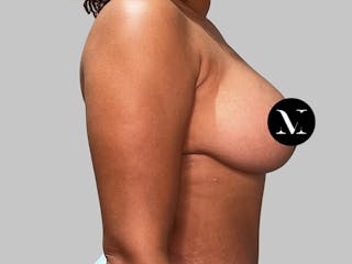 Breast Augmentation-Mastopexy Before & After Gallery - Patient 394357 - Image 4