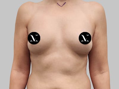 Breast Augmentation Before & After Gallery - Patient 258898 - Image 1