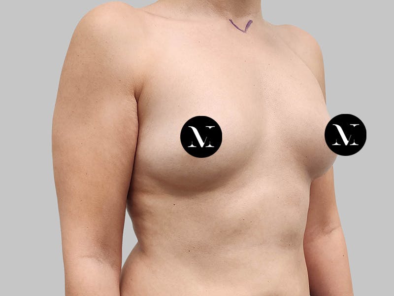 Breast Augmentation Before & After Gallery - Patient 258898 - Image 3