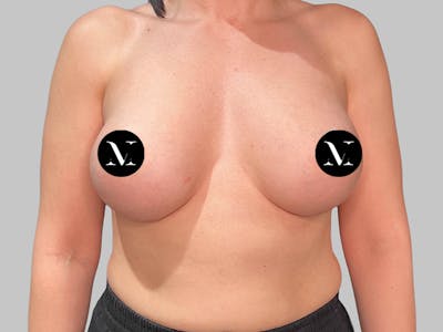 Breast Augmentation Before & After Gallery - Patient 258898 - Image 2