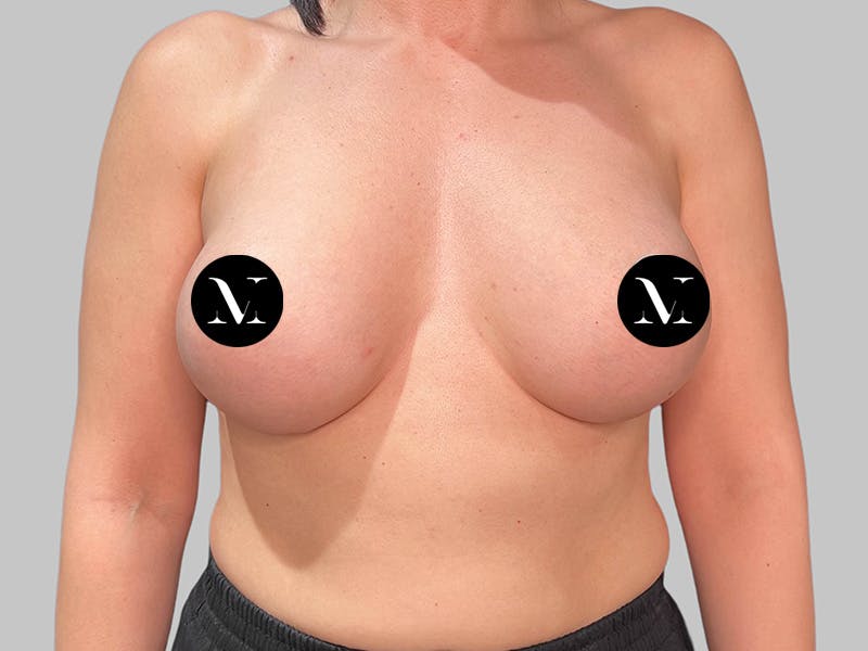 Breast Augmentation Before & After Gallery - Patient 258898 - Image 2