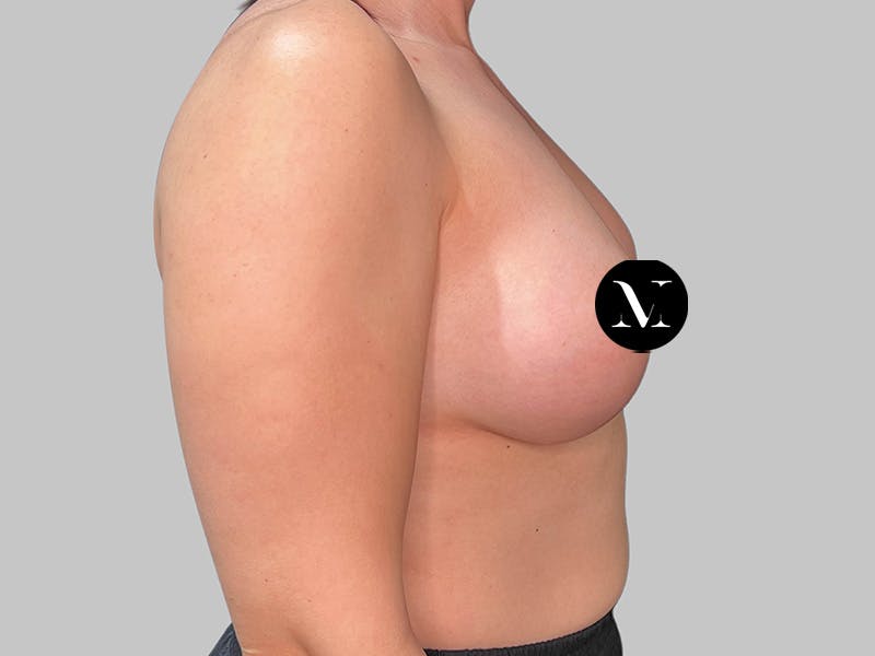 Breast Augmentation Before & After Gallery - Patient 258898 - Image 6