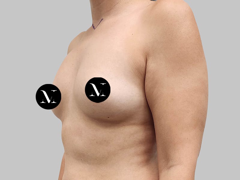 Breast Augmentation Before & After Gallery - Patient 258898 - Image 7