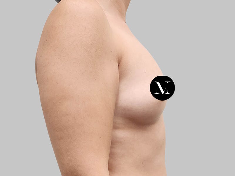 Breast Augmentation Before & After Gallery - Patient 258898 - Image 5
