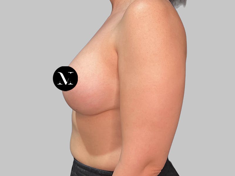 Breast Augmentation Before & After Gallery - Patient 258898 - Image 10