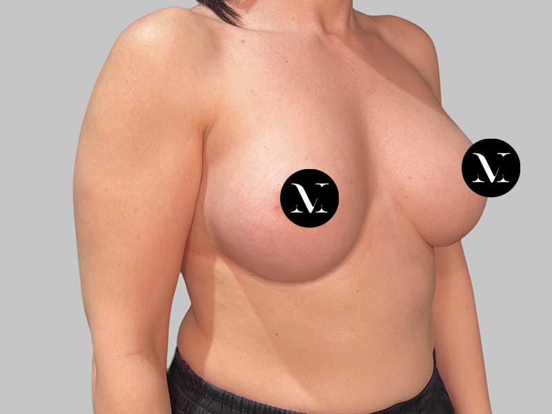 Breast Augmentation Before & After Gallery - Patient 258898 - Image 4