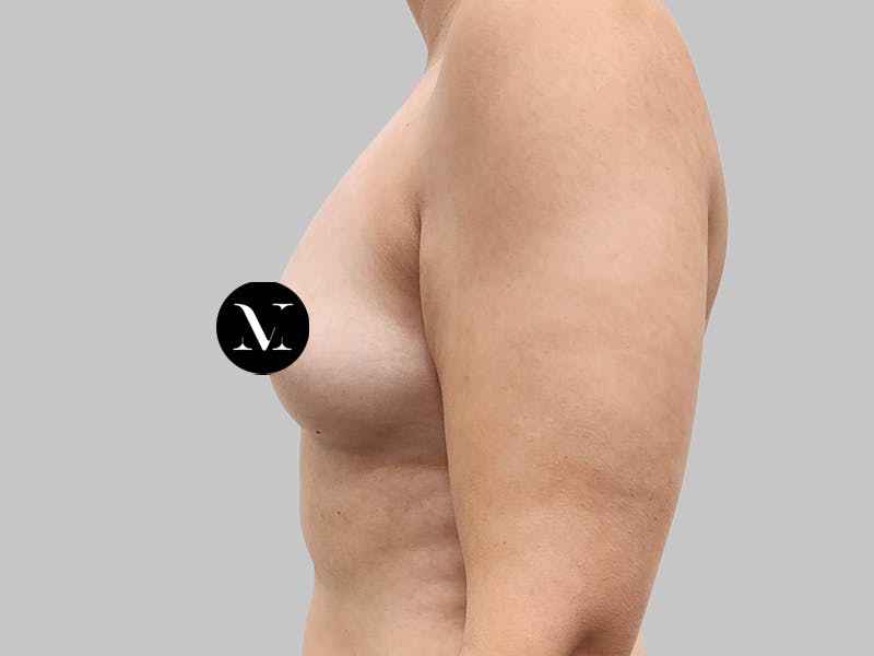 Breast Augmentation Before & After Gallery - Patient 258898 - Image 9