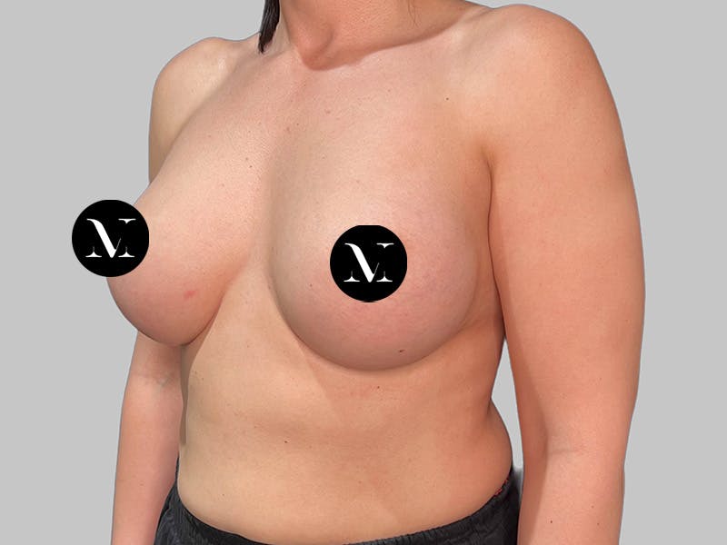 Breast Augmentation Before & After Gallery - Patient 258898 - Image 8