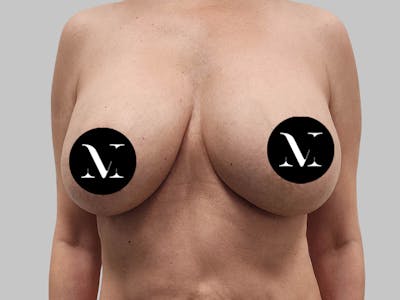 Breast Augmentation-Mastopexy Before & After Gallery - Patient 258371 - Image 1