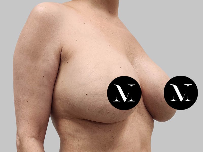 Breast Augmentation-Mastopexy Before & After Gallery - Patient 258371 - Image 3