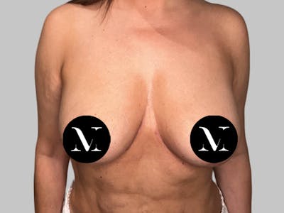 Breast Augmentation-Mastopexy Before & After Gallery - Patient 258371 - Image 2