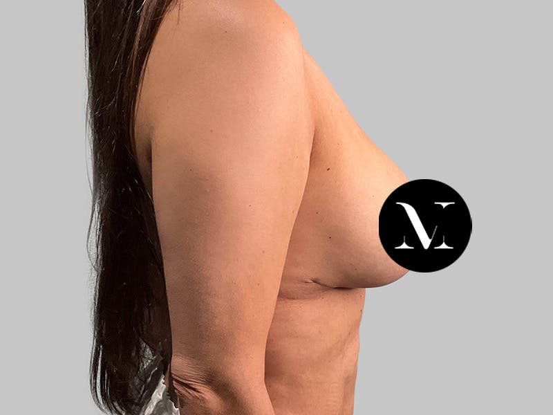 Breast Augmentation-Mastopexy Before & After Gallery - Patient 258371 - Image 6