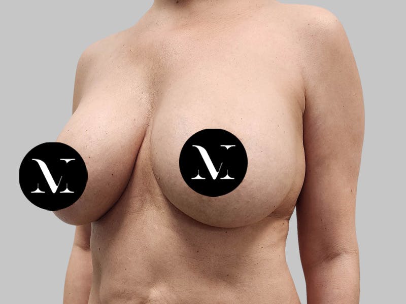 Breast Augmentation-Mastopexy Before & After Gallery - Patient 258371 - Image 7