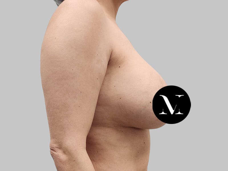 Breast Augmentation-Mastopexy Before & After Gallery - Patient 258371 - Image 5